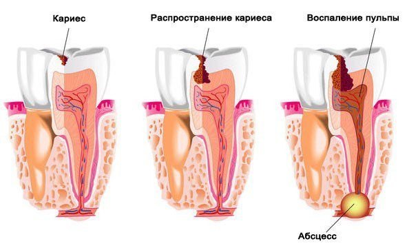 Профилактика кариеса – как остановить и предотвратить кариес зубов