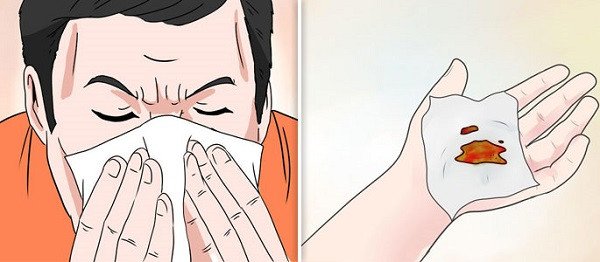 6 приемов, которые помогут быстро остановить кровотечение из носа.